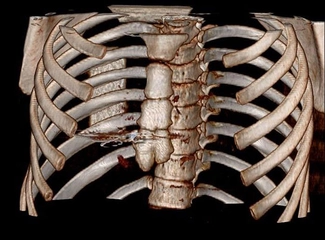 Göğüs Travmaları Belirtileri ve Tedavisi Göğüs Travmaları Belirtileri ve Tedavisi